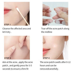 72/180Pcs Invisible Acne Patches Removal Pimple Anti-Acne Hydrocolloid Patches Spots Marks Concealer Repair Sticker Waterproof