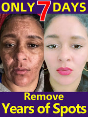 Freckle Whitening Cream Melasma Removal  Dark Spots Fade Brighten