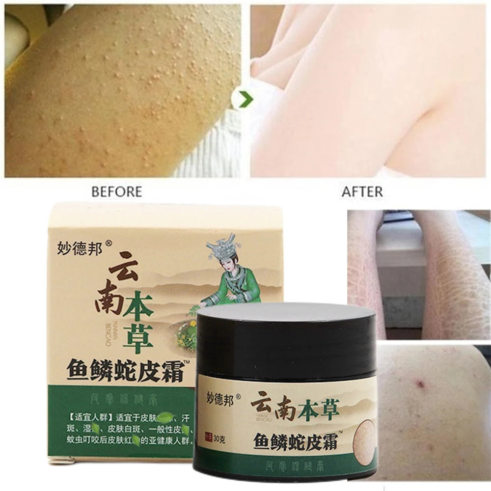 New Chicken Skin Repair Cream Curing Keratosis Follicle Pilaris Remove Thick Pores Body Dark Spot Moisturize Smooth Skin Care