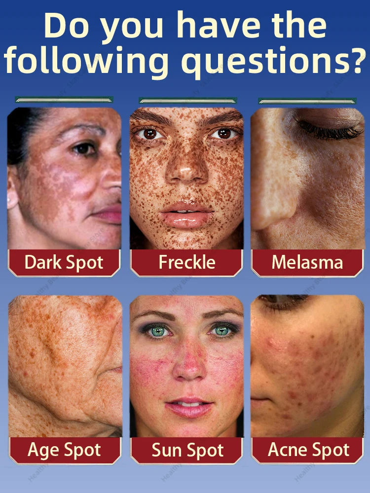 Freckle Whitening Cream Melasma Removal  Dark Spots Fade Brighten