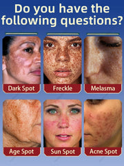 Freckle Whitening Cream Melasma Removal  Dark Spots Fade Brighten