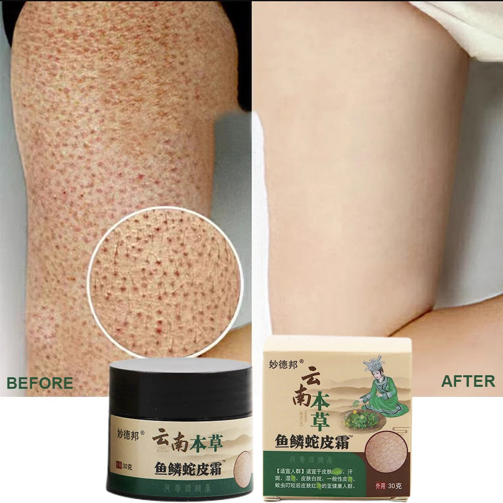 New Chicken Skin Repair Cream Curing Keratosis Follicle Pilaris Remove Thick Pores Body Dark Spot Moisturize Smooth Skin Care