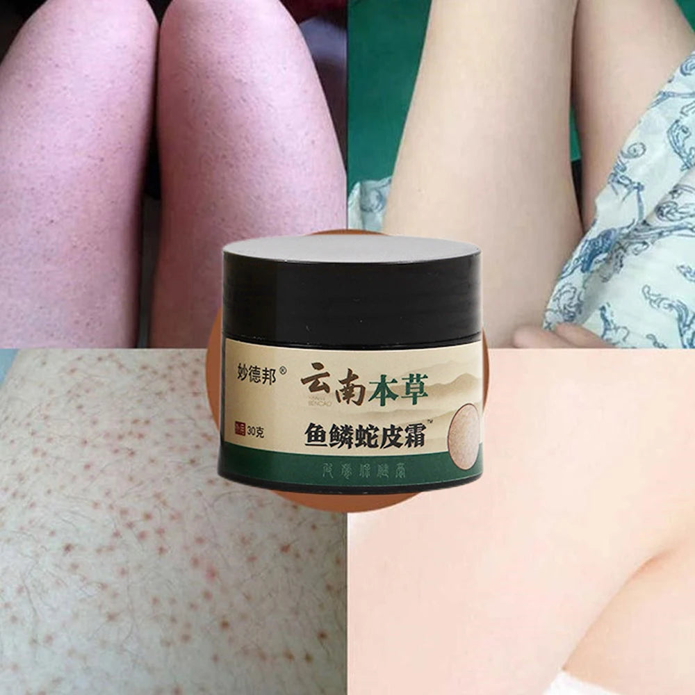 New Chicken Skin Repair Cream Curing Keratosis Follicle Pilaris Remove Thick Pores Body Dark Spot Moisturize Smooth Skin Care